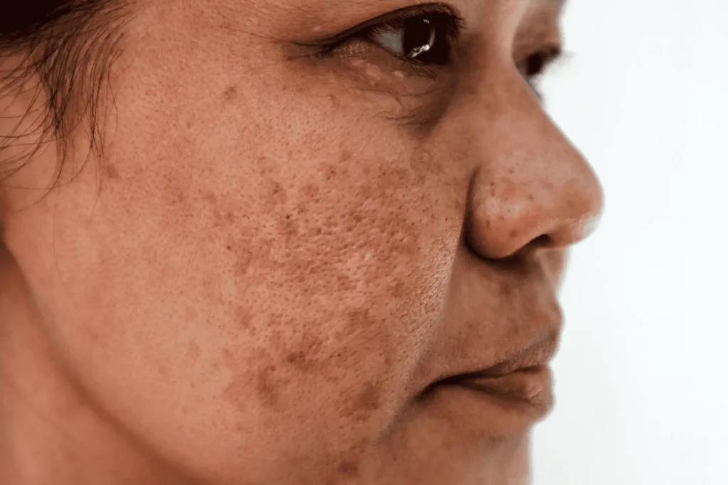 Cryosonic Repair Sun-Damaged Skin Alton Alton
