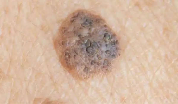 Seborrhoeic Keratosis: Benign vs Malignant Alton