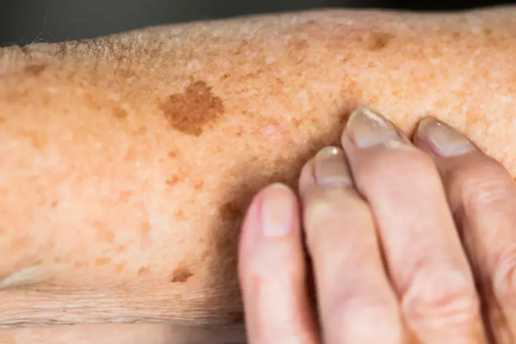 Why Is Early Treatment of Sun Damage Important Alton? Alton