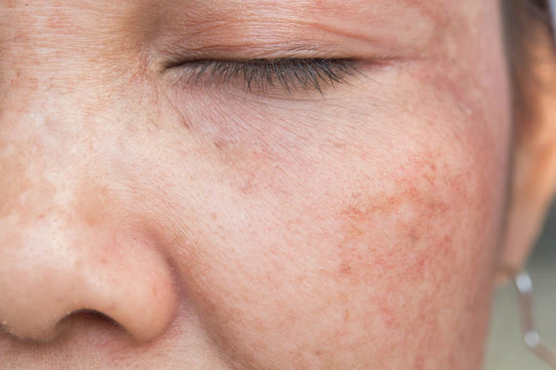 UV rays affecting skin cells, showing sun damage and the need for Cryosonic repair treatments Alton. Alton