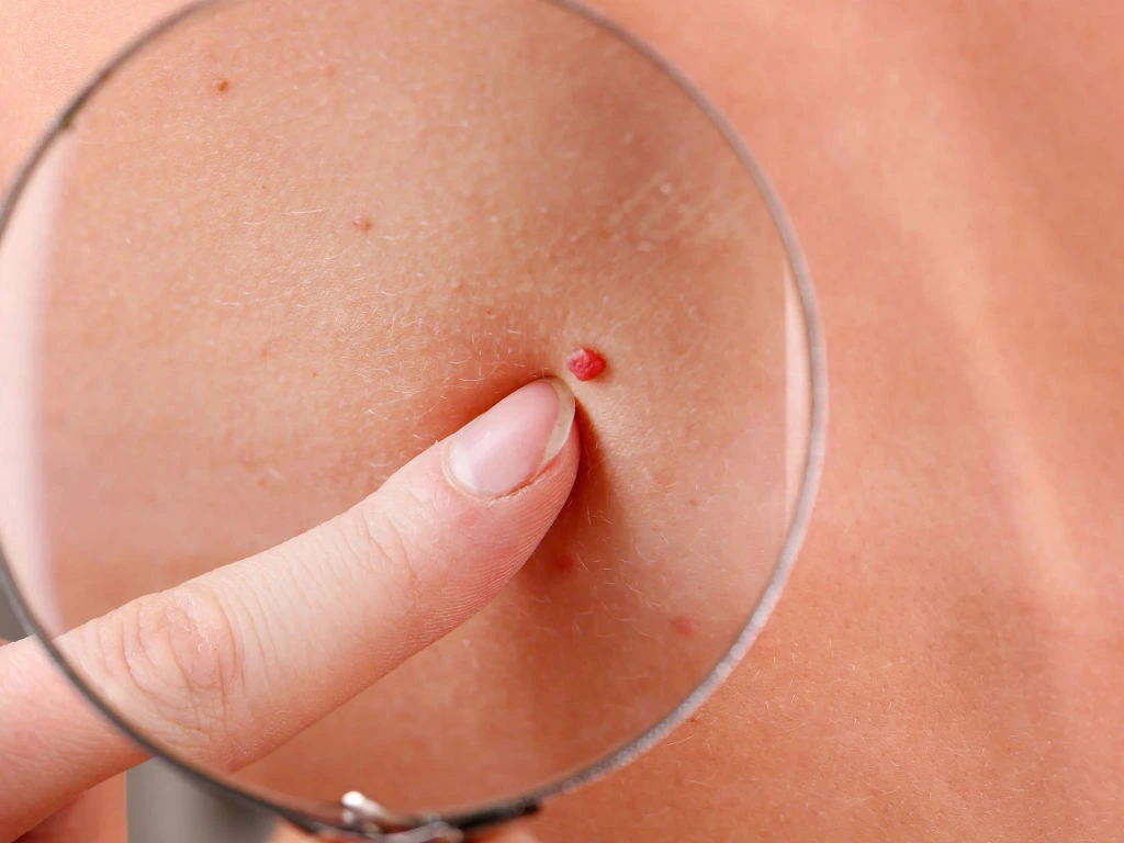 Cherry Angiomas on skin showing vascular structure and Cryosonic CryoPen treatment for effective lesion removal Alton