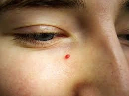 Benefits of Cryosonic CryoPen for Cherry Angiomas Alton , showing precise, safe, and effective removal of vascular skin lesions Alton