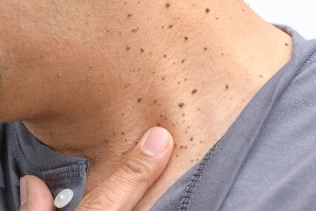 Benefits of Cryosonic CryoPen Alton for darker skin, highlighting safe, fast, and precise removal of Dermatosis Papulosa Nigra Alton