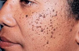 Cryosonic CryoPen treatment Alton showing Dermatosis Papulosa Nigra on darker skin Alton