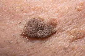 Role of CryoPen in managing Seborrhoeic Keratosis Alton – safe and effective lesion removal Alton