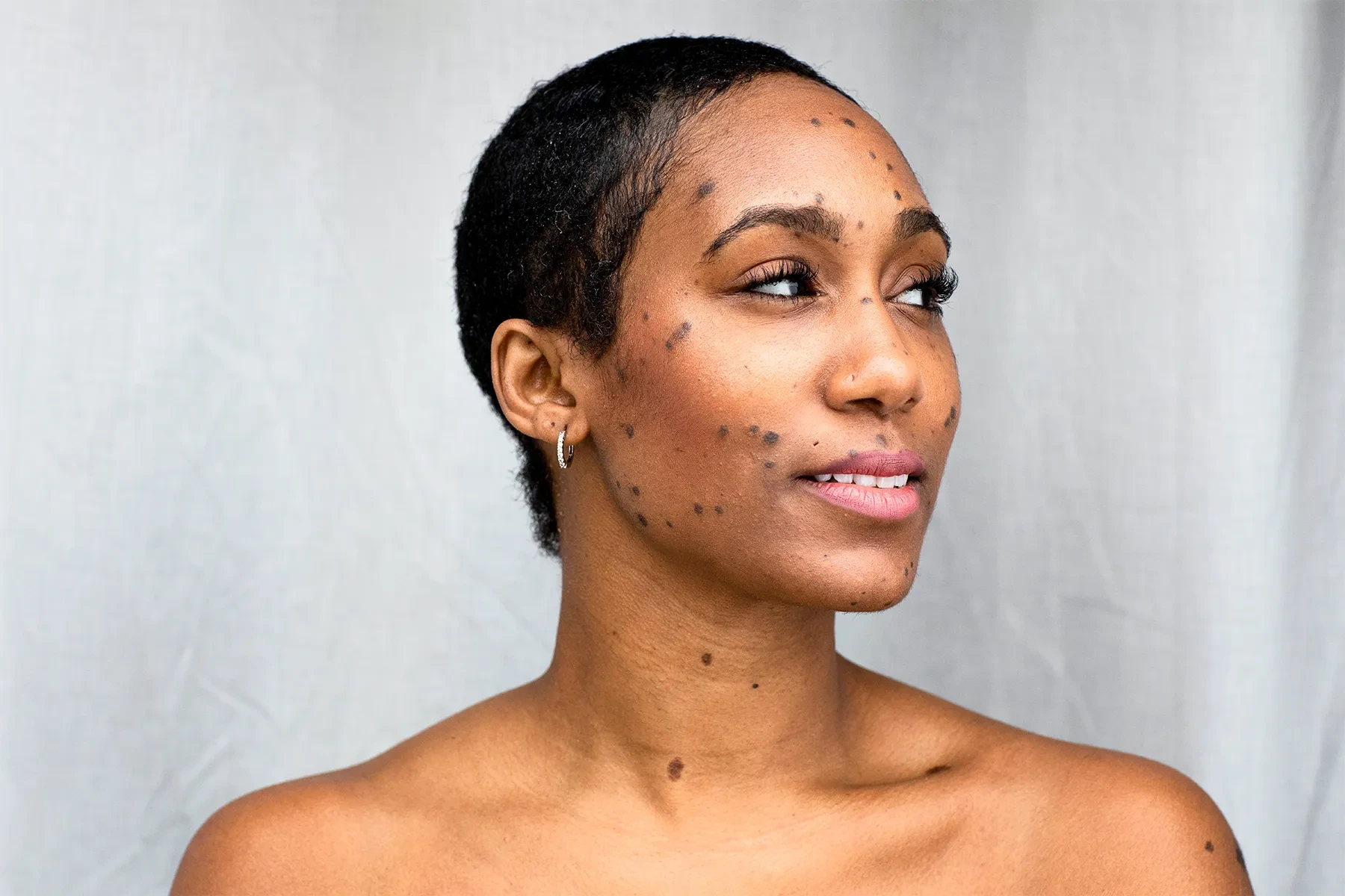 Dermatosis Papulosa Nigra on darker skin treated with Cryosonic CryoPen, showing genetic factors and effective removal Alton