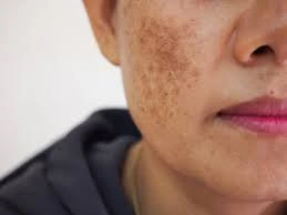 skin showing uneven tone and dark patches caused by Solar Lentigines Alton age spots on sun-exposed areas Alton