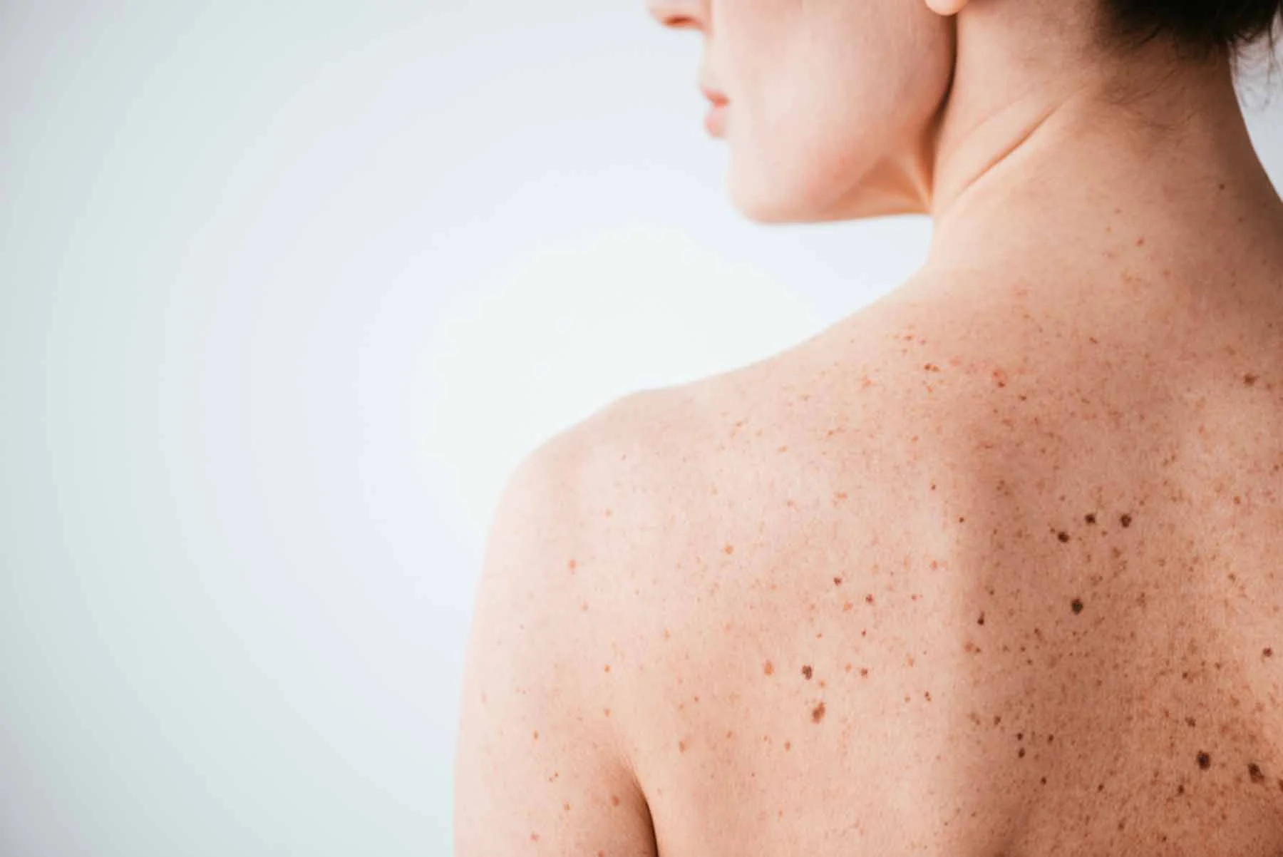 Sun Damage : Understanding UV Effects and Skin Repair Options Alton
