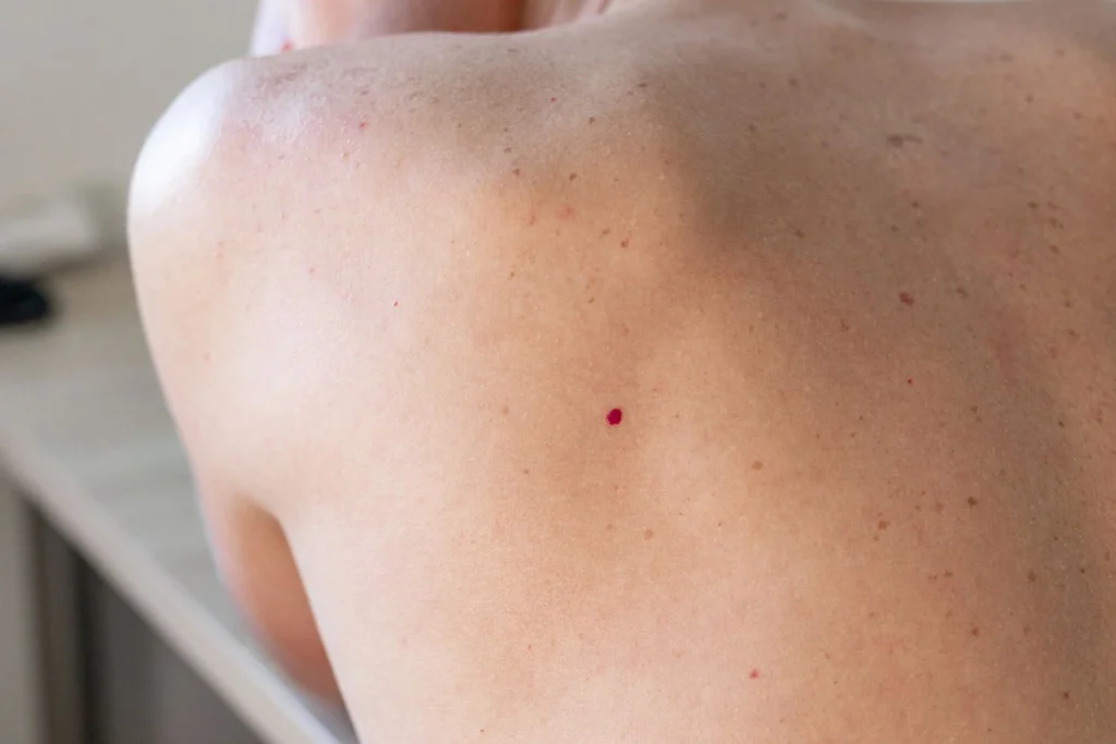 Close-up of Cherry Angiomas Alton on skin, showing small red vascular lesions and their typical appearance Alton