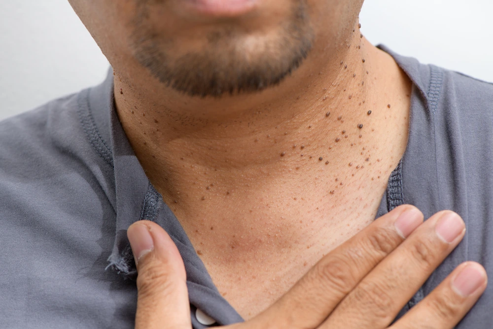 Dermatosis Papulosa Nigra Alton on darker skin, showing genetic factors Alton