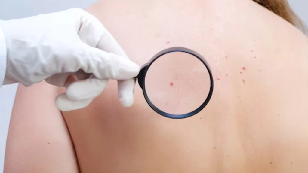 Person considering Cherry Angiomas Alton removal, highlighting cosmetic and comfort reasons for treatment with CryoPen Alton